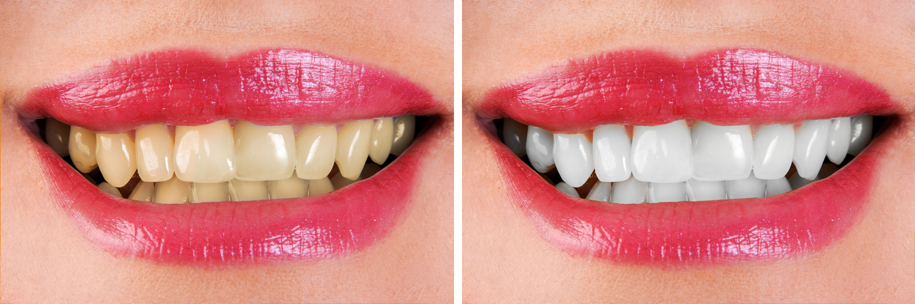 Tooth whitening - before & after